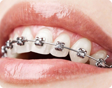 Orthodontic main