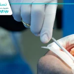 ایمپلنت دندان چیست: مهمترین نکات کاشت دندان