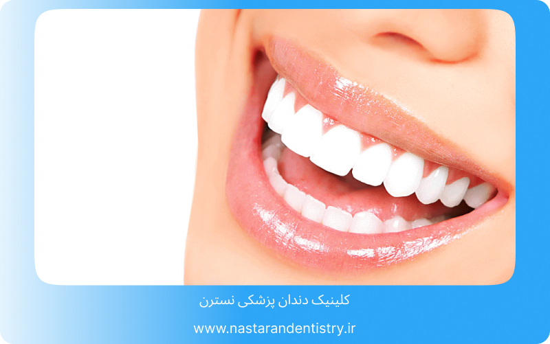 عمر لمینت بیشتر است یا کامپوزیت؟2