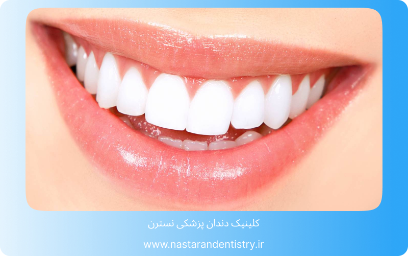 عمر لمینت بیشتر است یا کامپوزیت؟1