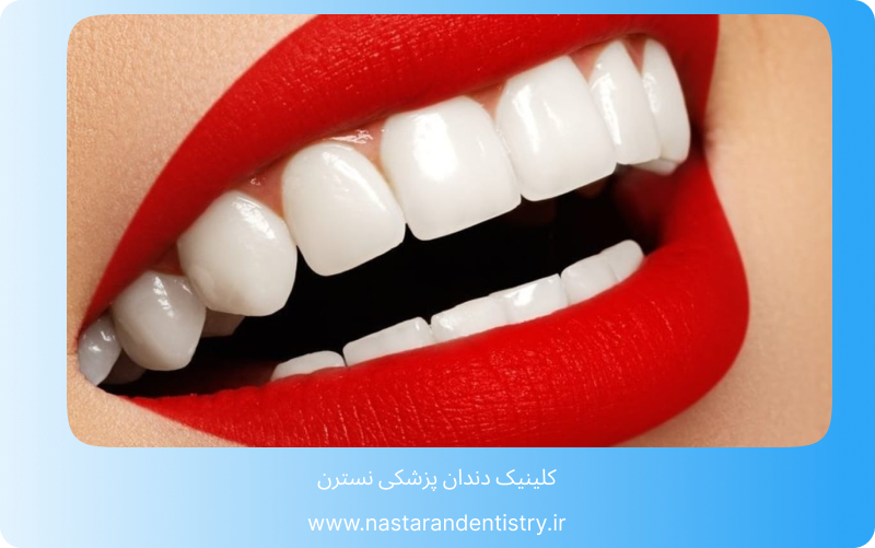 عمر لمینت بیشتر است یا کامپوزیت؟4