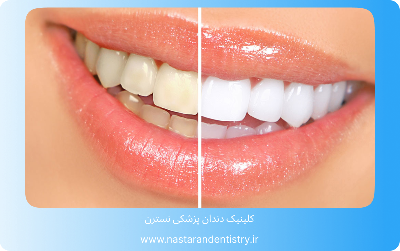 عمر لمینت بیشتر است یا کامپوزیت؟3