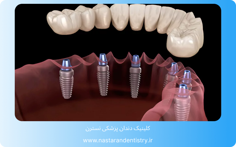 عمر ایمپلنت اشترومن