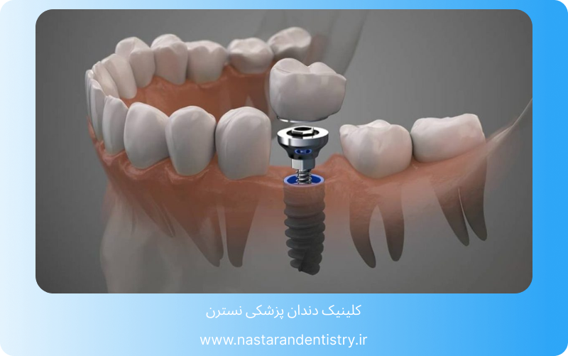 عمر ایمپلنت اشترومن