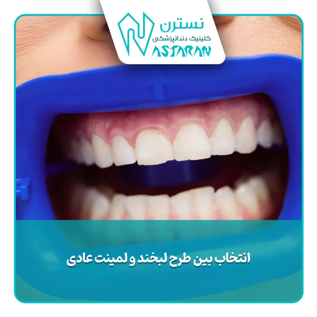 انتخاب بین طرح لبخند و لمینت عادی