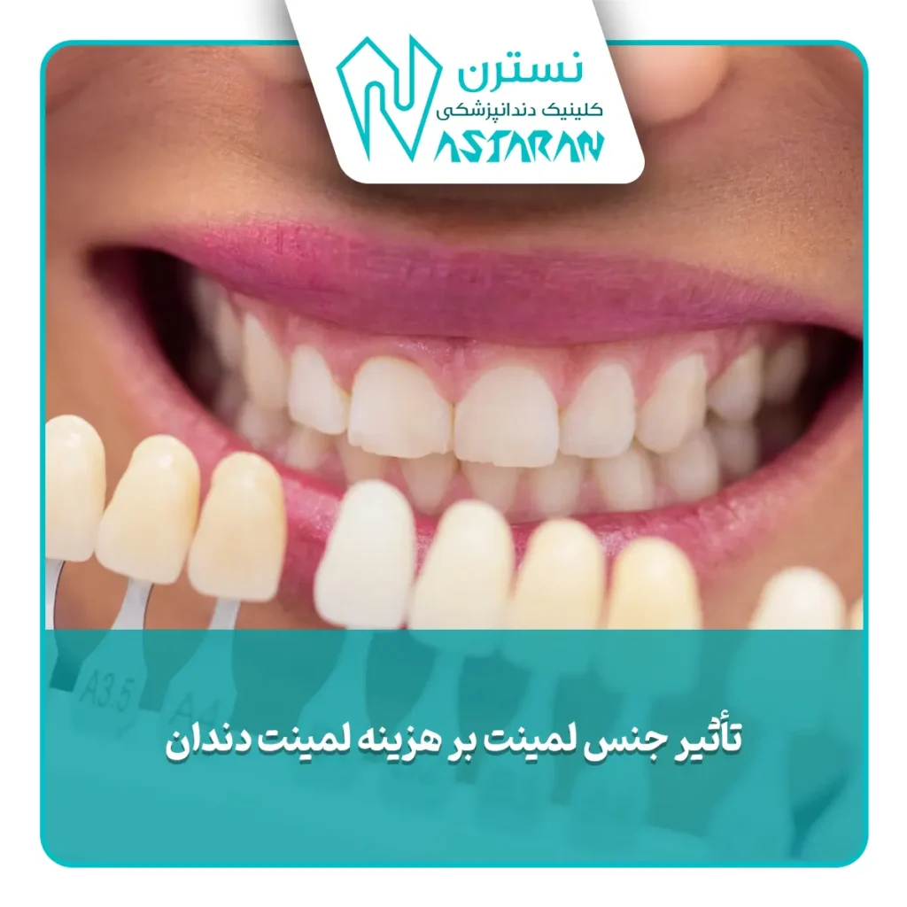 تأثیر جنس لمینت بر هزینه لمینت دندان