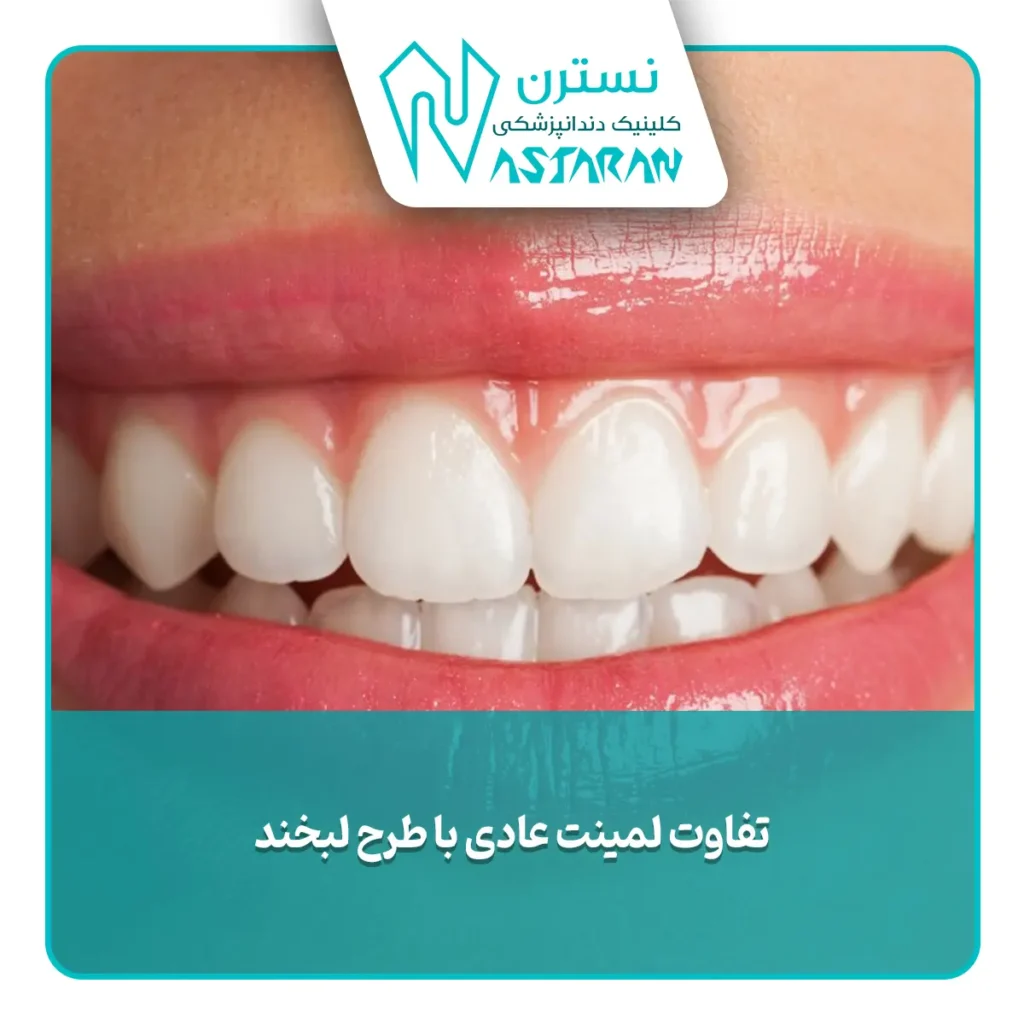 تفاوت قیمت لمینت عادی با طرح لبخند