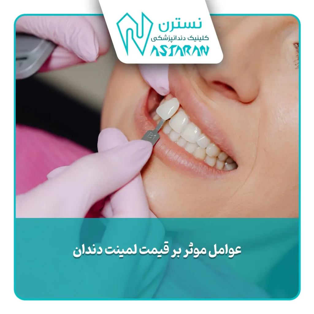 عوام مؤثر بر قیمت لمینت دندان طرح لبخند