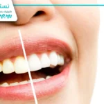 قیمت لمینت دندان طرح لبخند (هزینه لمینت دندان ۱۴۰۴)