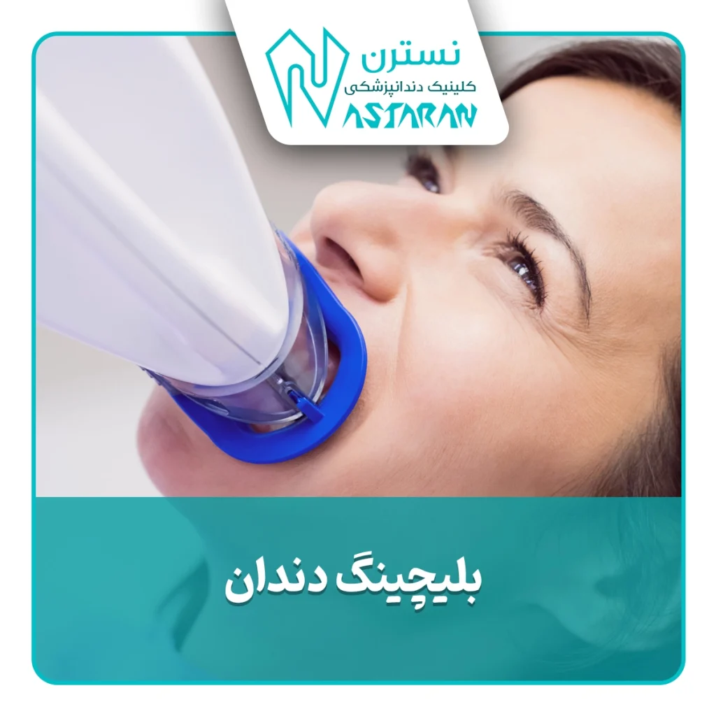 بلیچینگ دندان