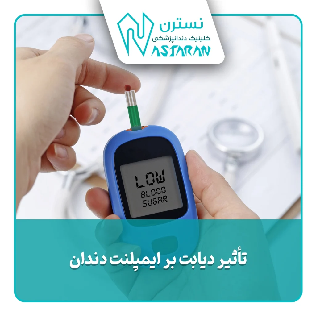 تأثیر دیابت بر ایمپلنت دندان بررسی عوامل موفقیت و موانع