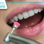 جرم گیری دندان کلید کنترل دیابت