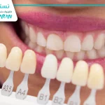 روکش دندان (Crown): انواع مواد مورد استفاده در ساخت تاج مصنوعی