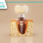 قیمت ایمپلنت دندان با روکش و جراحی در تهران - مهر 1404