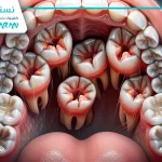 جراحی دندان نهفته با لیزر : انواع نهفتگی و تأثیر آن روی اعصاب فک