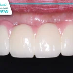 جراحی پیوند لثه توسط جراح فک و صورت