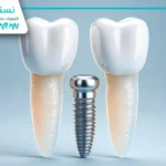 ایمپلنت فوری در ۲۴ ساعت: ایمپلنت ۱ روزه واقعیت یا تبلیغات؟