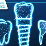 ایمپلنت دیجیتال با بیهوشی: انقلابی در کاشت دندان