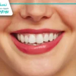 لمینت بدون تراش؛ زیبایی بدون آسیب به مینای دندان