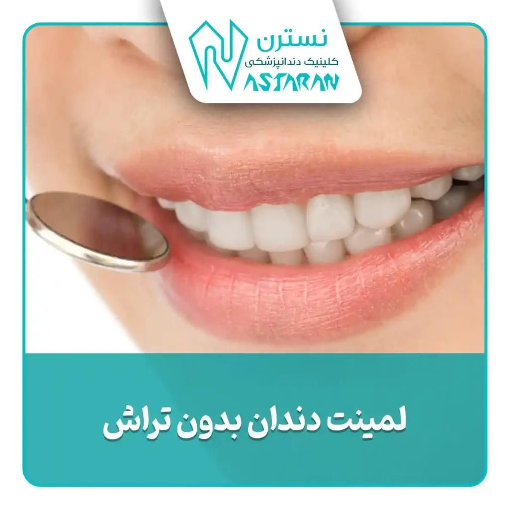 لمینت دندان بدون تراش