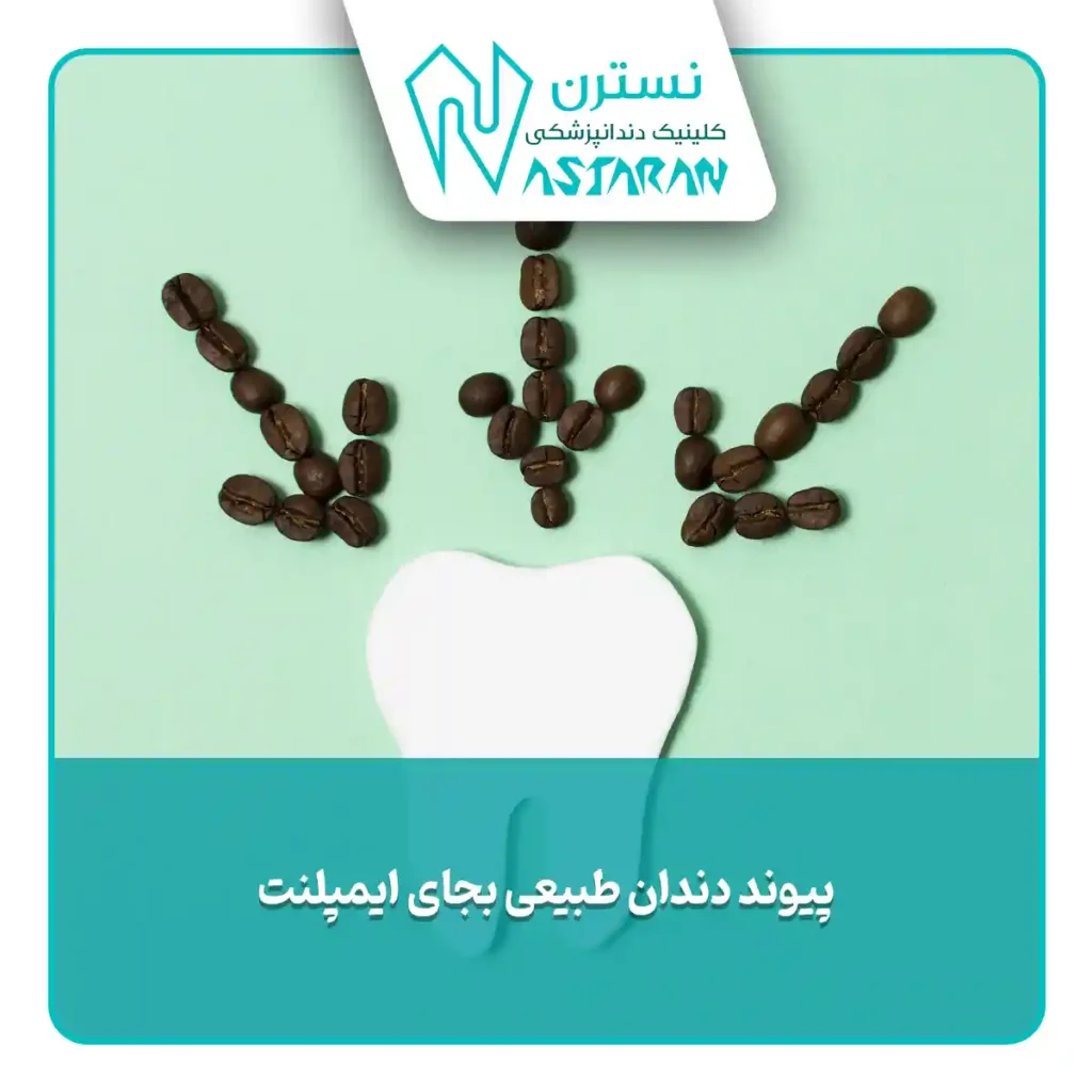 دندان طبیعی بجای ایمپلنت