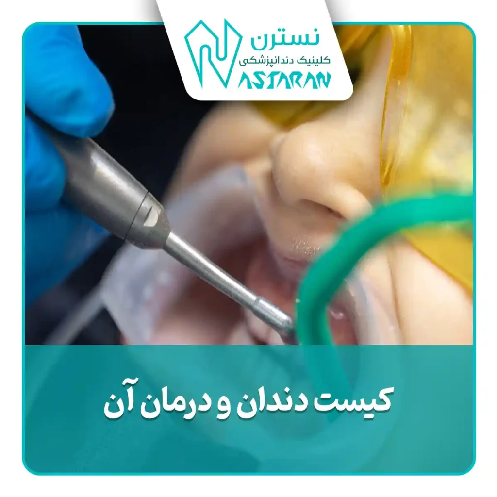 کیست دندان و روش درمان