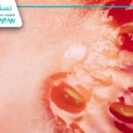 کیست دندان و روش‌های جراحی آن