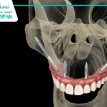 ایمپلنت دندان زیگوماتیک