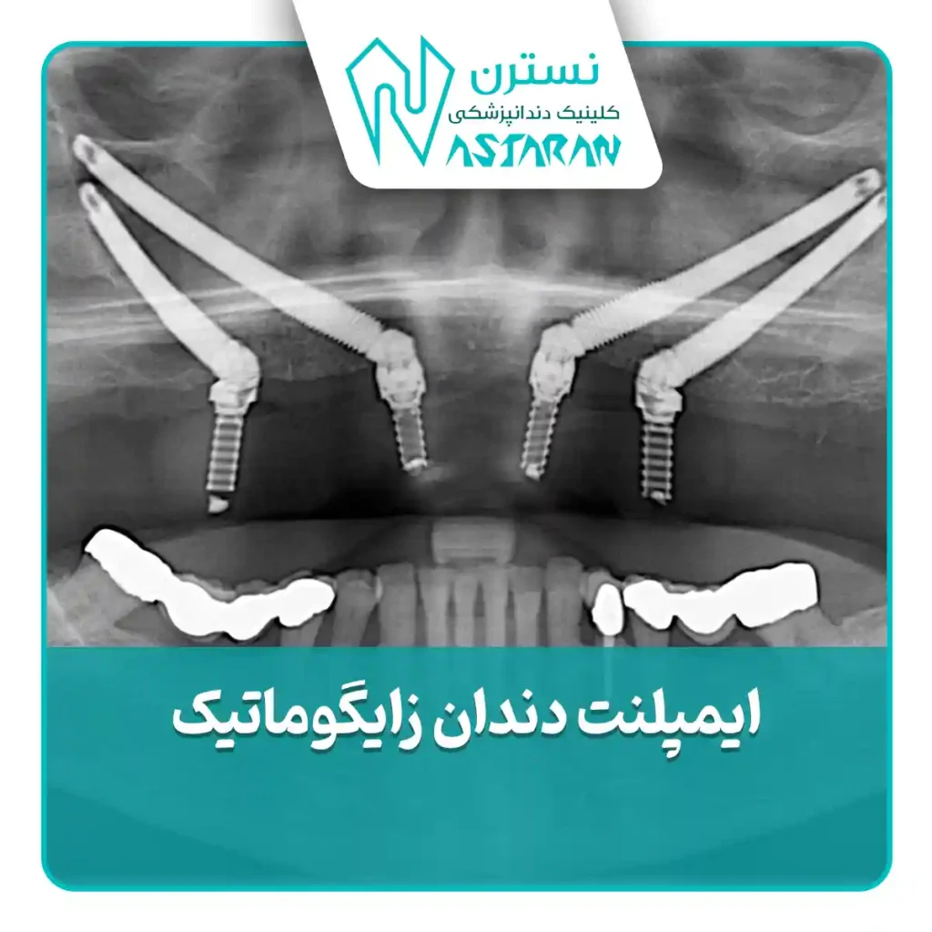 ایمپلنت دندان زایگوماتیک