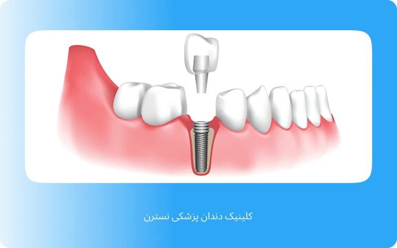 مراحل ایمپلنت دندان جلو (1)