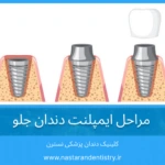ایمپلنت دندان جلو: مراحل جراحی از 0 تا 100