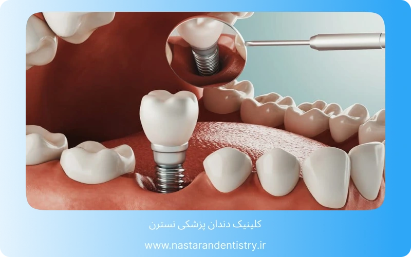مراحل ایمپلنت دندان جلو (3)