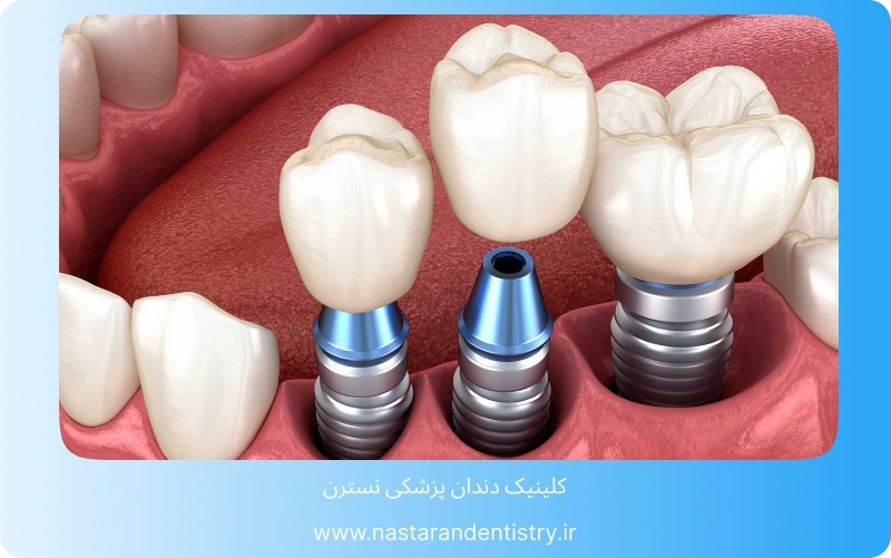 مراحل ایمپلنت دندان جلو (5)