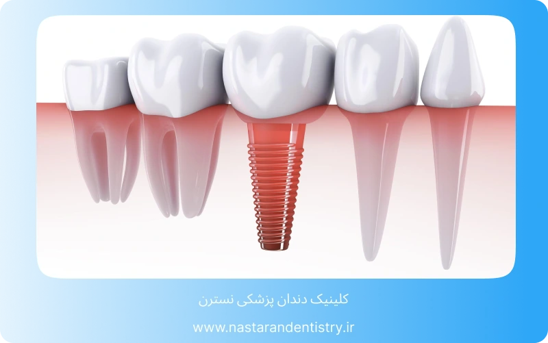 دندانپزشکی بزرگسالان لبخندی زیبا در هر سنی (3)