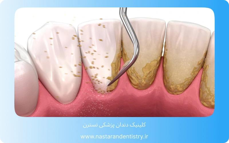 دندانپزشکی بزرگسالان لبخندی زیبا در هر سنی (5)