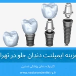 هزینه ایمپلنت دندان جلو در تهران