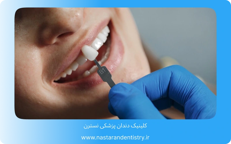 همه چیز درباره لمینت سرامیکی در تهران (2)