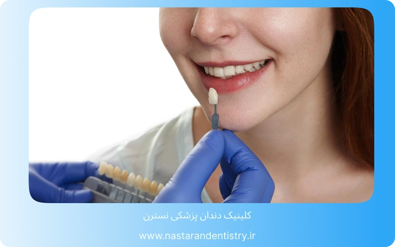 همه چیز درباره لمینت سرامیکی در تهران (3)