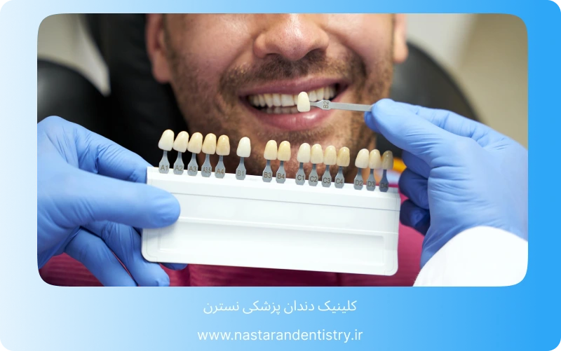 همه چیز درباره لمینت سرامیکی در تهران (5)