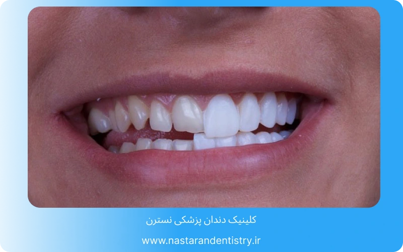 آیا کامپوزیت دندان دائمی است