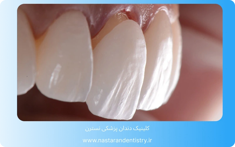 آیا کامپوزیت دندان دائمی است