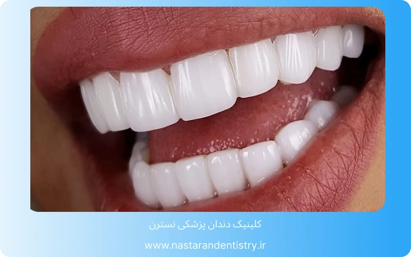 آیا کامپوزیت دندان دائمی است