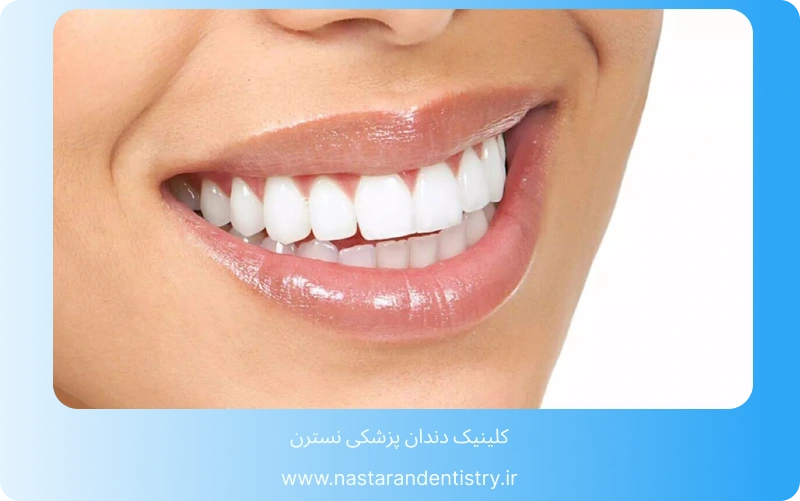 آیا کامپوزیت دندان دائمی است