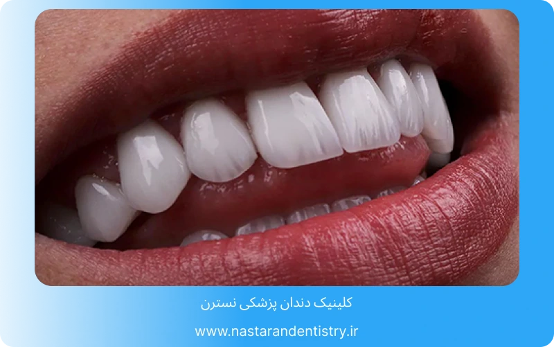 بهترین لمینت سرامیکی در تهران