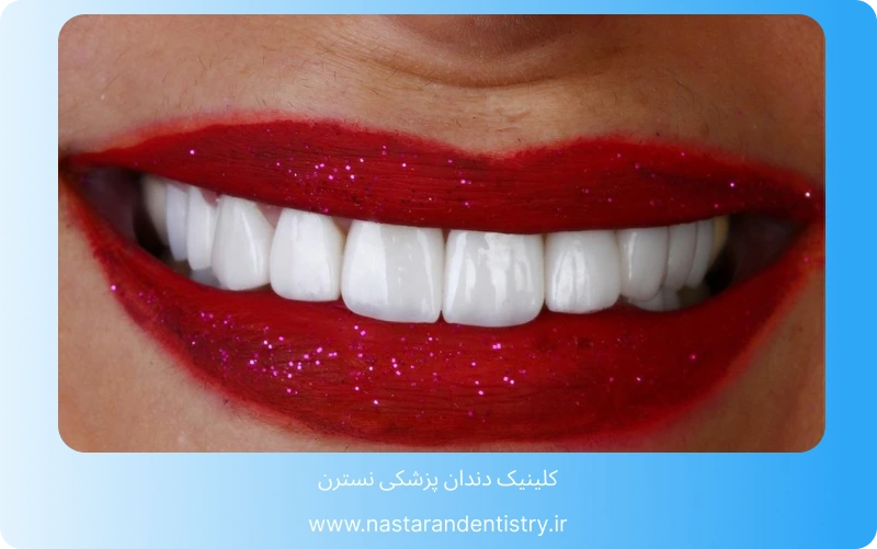 بهترین لمینت سرامیکی در تهران