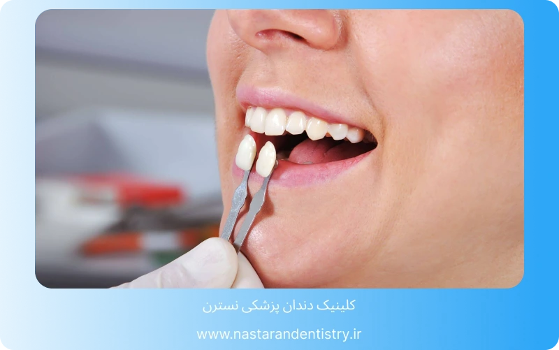 بهترین لمینت سرامیکی در تهران