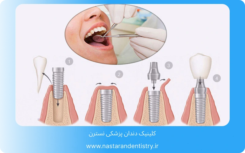 بهترین کلینیک ایمپلنت در تهران