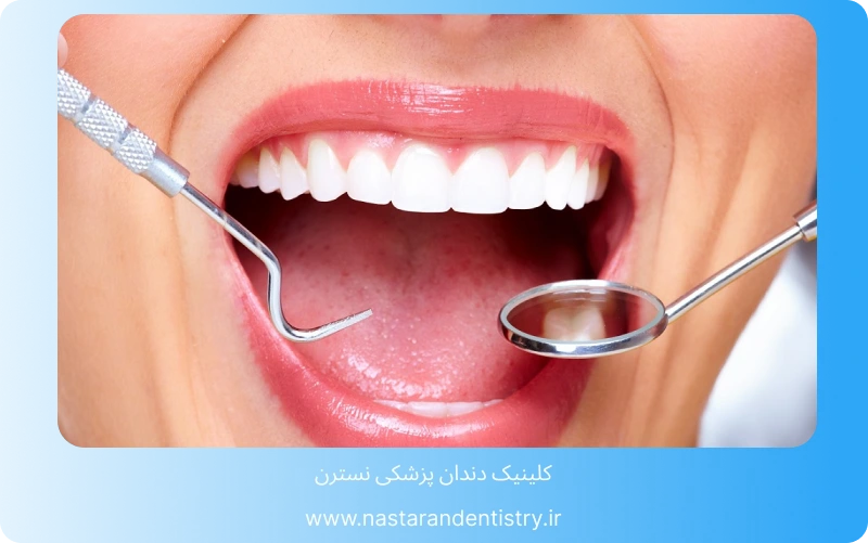 بهترین لمینت سرامیکی در تهران