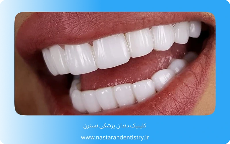 بهترین مرکز کامپوزیت دندان در تهران (2)
