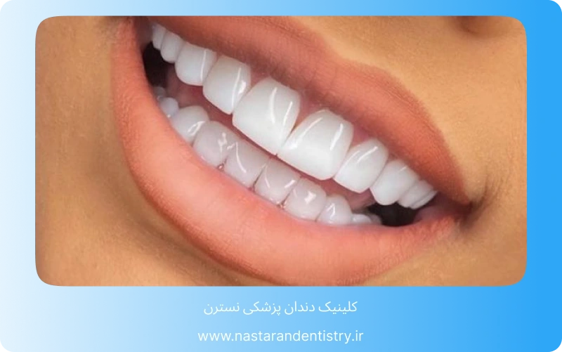 بهترین مرکز کامپوزیت دندان در تهران (3)